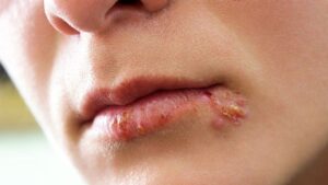 cold-sores-symptoms